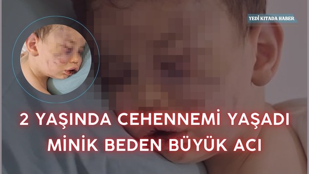 2 Yaşında Cehennemi Yaşadı: Minik Beden, Büyük Acı