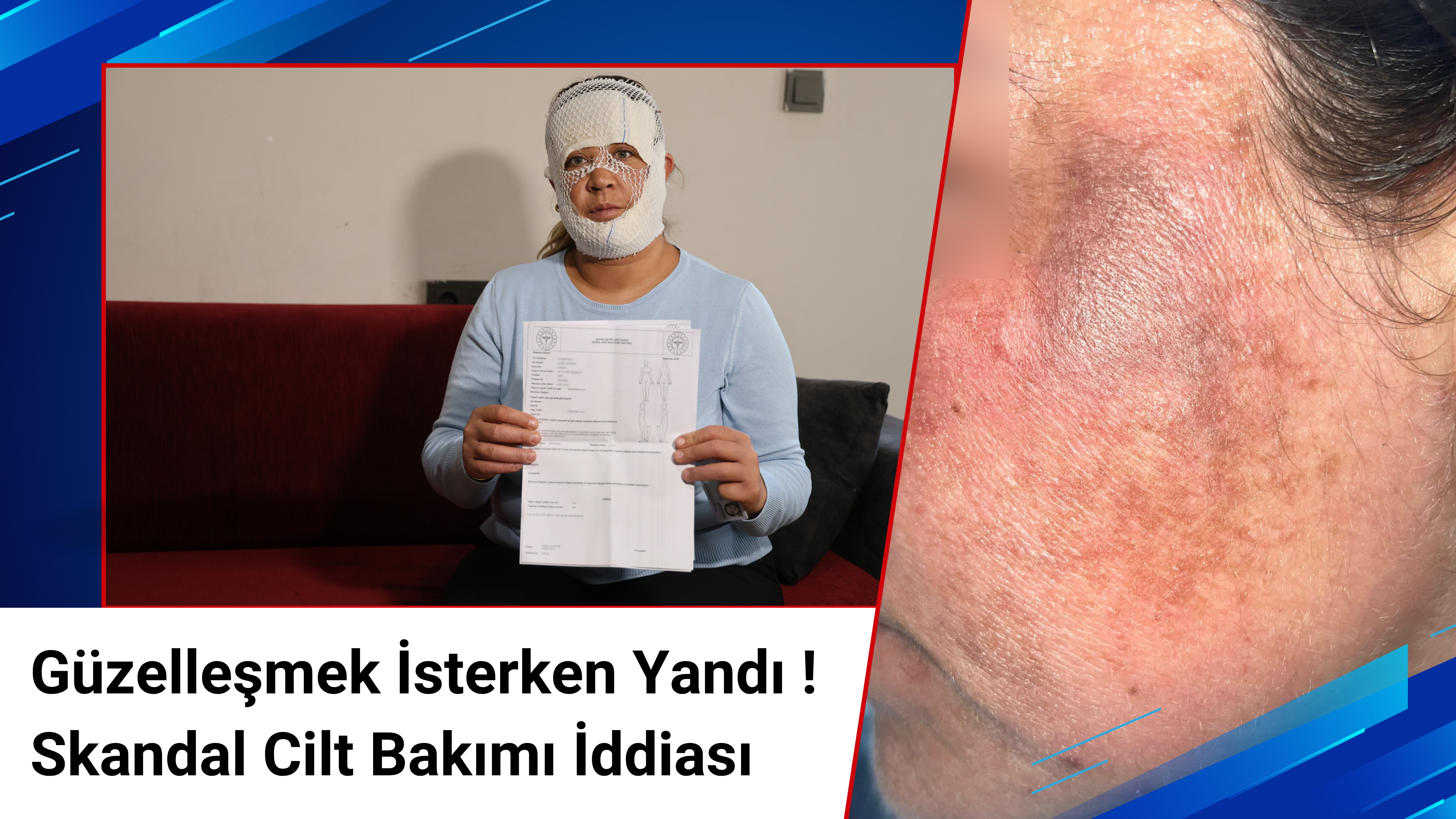 Güzelleşmek uğruna gittiği merkezde yüzü yandı